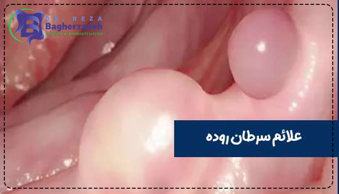 علائم سرطان روده